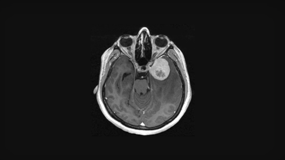 MRI image of brain with a meningioma tumour